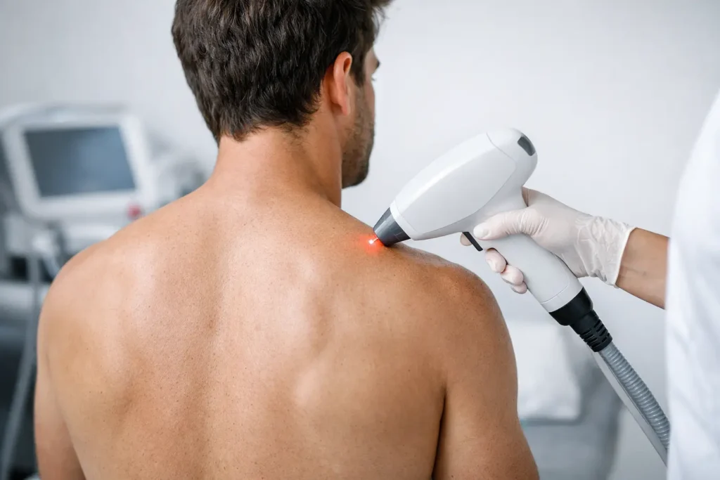 Epilazione laser uomo schiena: cosa sapere